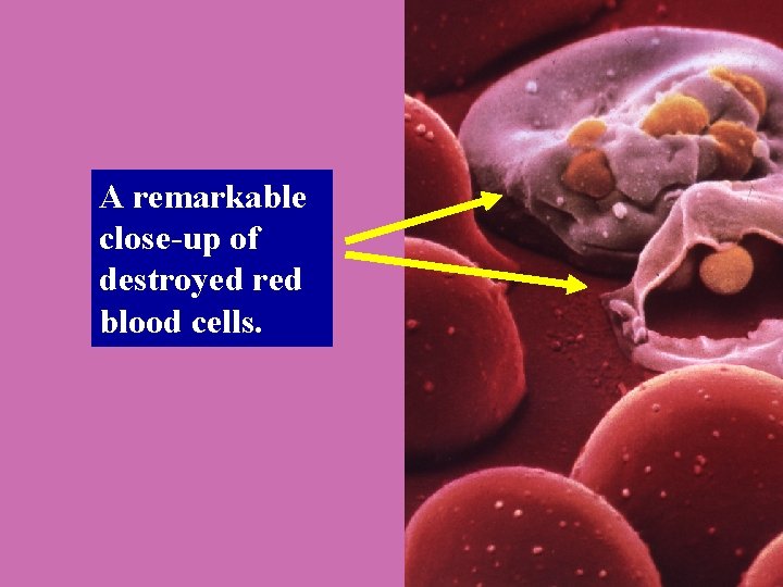 A remarkable close-up of destroyed red blood cells. 