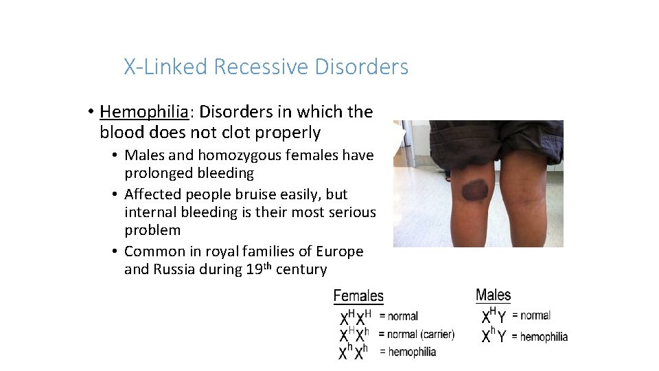 X-Linked Recessive Disorders • Hemophilia: Disorders in which the blood does not clot properly