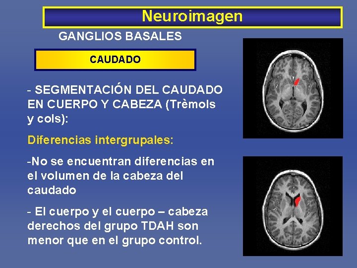 Neuroimagen GANGLIOS BASALES CAUDADO - SEGMENTACIÓN DEL CAUDADO EN CUERPO Y CABEZA (Trèmols y