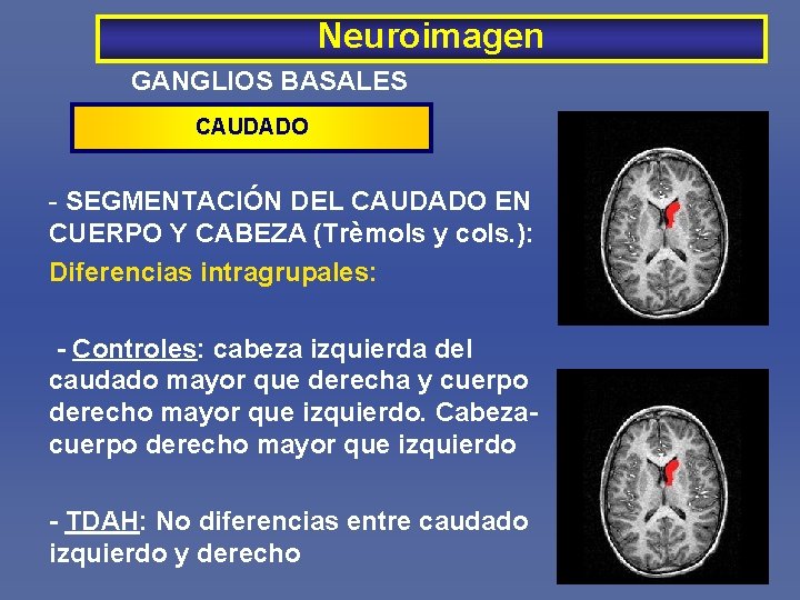 Neuroimagen GANGLIOS BASALES CAUDADO - SEGMENTACIÓN DEL CAUDADO EN CUERPO Y CABEZA (Trèmols y