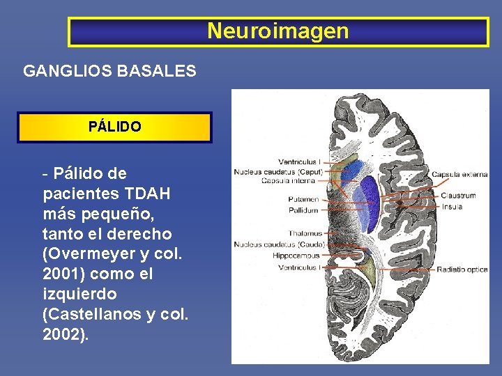 Neuroimagen GANGLIOS BASALES PÁLIDO - Pálido de pacientes TDAH más pequeño, tanto el derecho