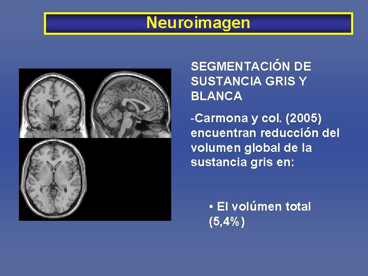 Neuroimagen SEGMENTACIÓN DE SUSTANCIA GRIS Y BLANCA -Carmona y col. (2005) encuentran reducción del