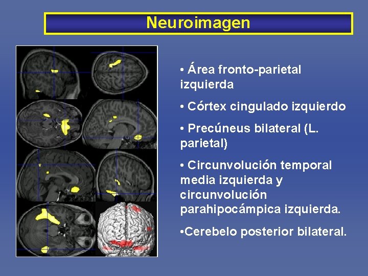 Neuroimagen • Área fronto-parietal izquierda • Córtex cingulado izquierdo • Precúneus bilateral (L. parietal)