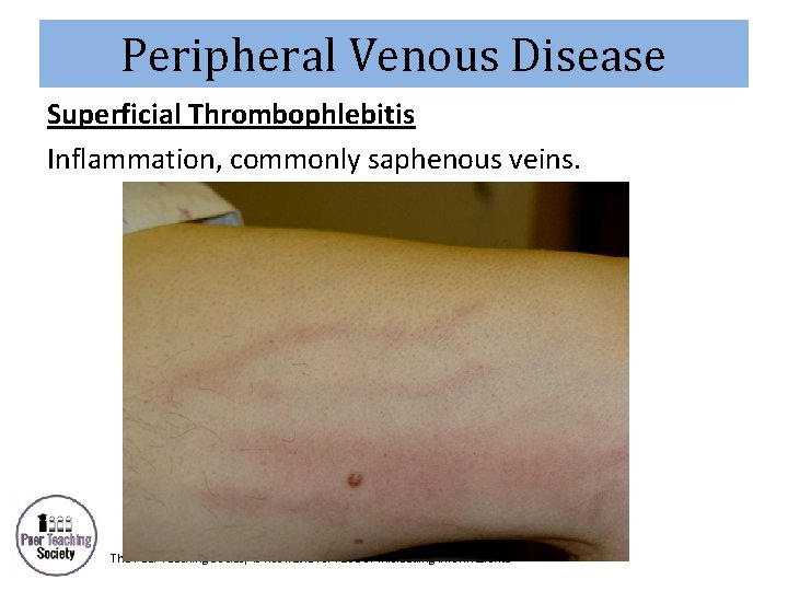 Peripheral Venous Disease Superficial Thrombophlebitis Inflammation, commonly saphenous veins. The Peer Teaching Society is