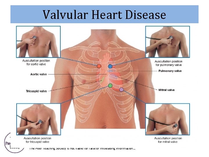 Valvular Heart Disease The Peer Teaching Society is not liable for false or misleading