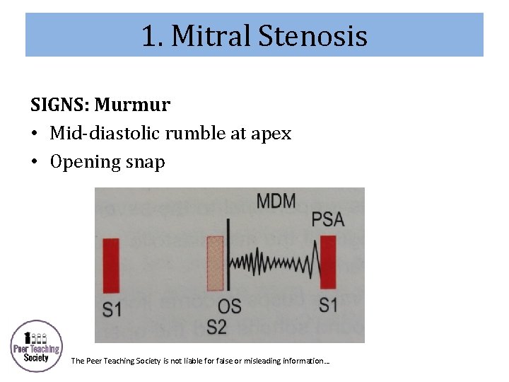 1. Mitral Stenosis SIGNS: Murmur • Mid-diastolic rumble at apex • Opening snap The