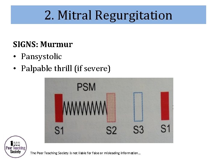 2. Mitral Regurgitation SIGNS: Murmur • Pansystolic • Palpable thrill (if severe) The Peer