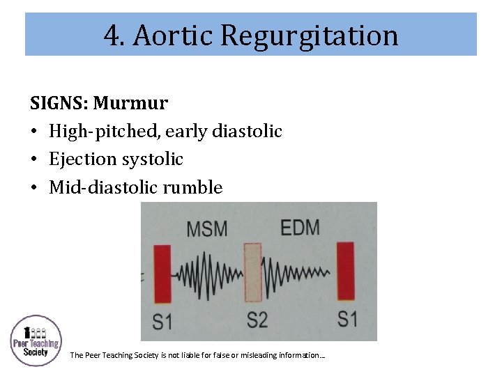 4. Aortic Regurgitation SIGNS: Murmur • High-pitched, early diastolic • Ejection systolic • Mid-diastolic
