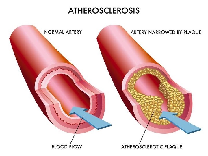 Atherosclerosis • Risk factors • Typical lesion = fatty streak • Cellular components –