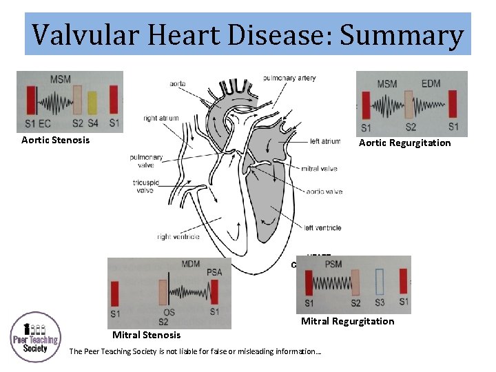 Valvular Heart Disease: Summary Aortic Stenosis Aortic Regurgitation Mitral Stenosis The Peer Teaching Society