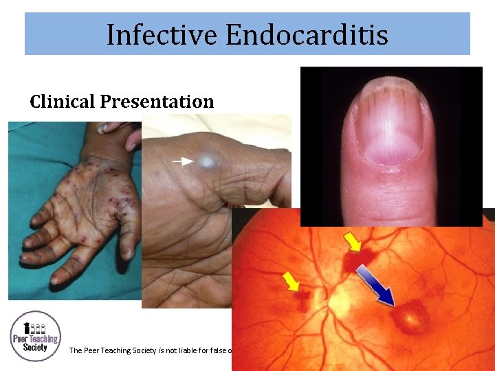 Infective Endocarditis Clinical Presentation The Peer Teaching Society is not liable for false or