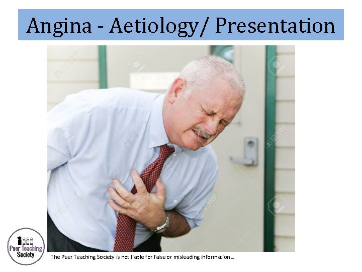 Angina - Aetiology/ Presentation The Peer Teaching Society is not liable for false or