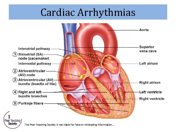 Cardiac Arrhythmias The Peer Teaching Society is not liable for false or misleading information…