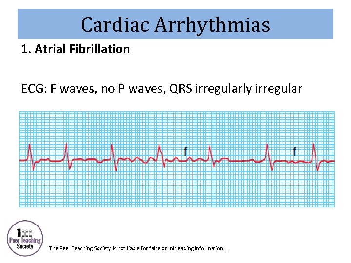 Cardiac Arrhythmias 1. Atrial Fibrillation ECG: F waves, no P waves, QRS irregularly irregular
