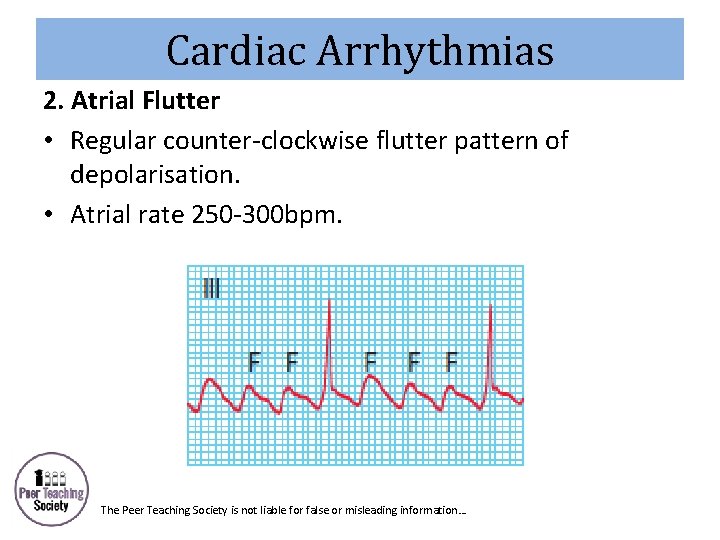Cardiac Arrhythmias 2. Atrial Flutter • Regular counter-clockwise flutter pattern of depolarisation. • Atrial