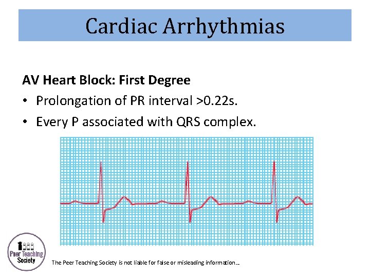 Cardiac Arrhythmias AV Heart Block: First Degree • Prolongation of PR interval >0. 22