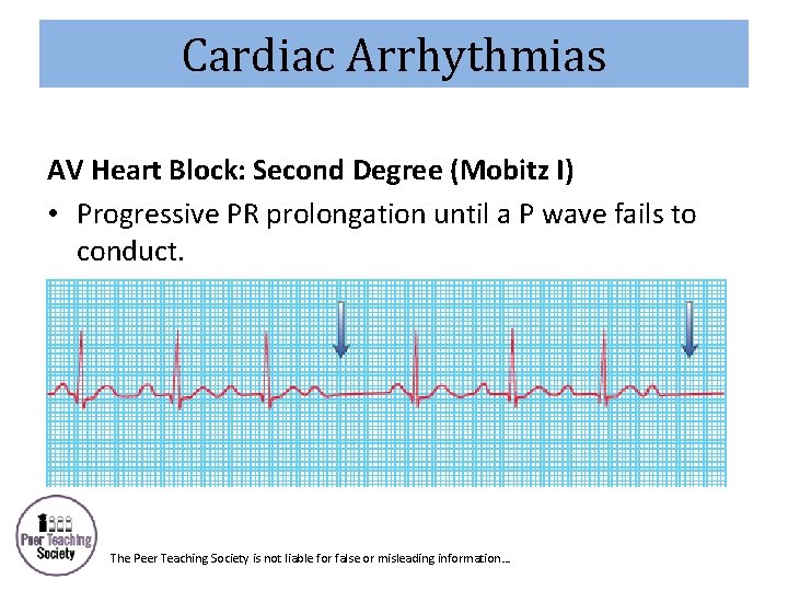 Cardiac Arrhythmias AV Heart Block: Second Degree (Mobitz I) • Progressive PR prolongation until