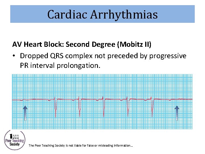 Cardiac Arrhythmias AV Heart Block: Second Degree (Mobitz II) • Dropped QRS complex not