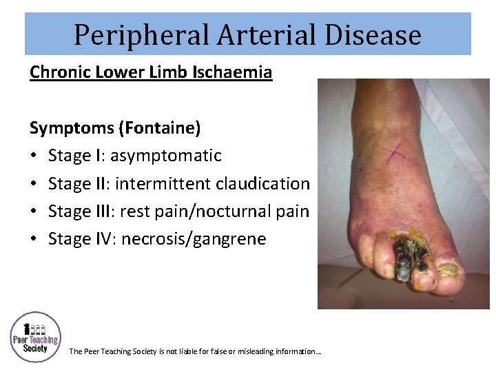 Peripheral Arterial Disease Chronic Lower Limb Ischaemia Symptoms (Fontaine) • Stage I: asymptomatic •