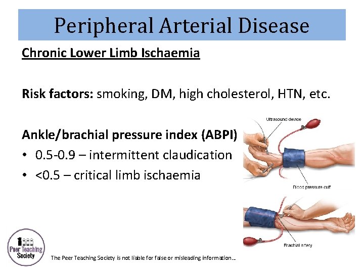 Peripheral Arterial Disease Chronic Lower Limb Ischaemia Risk factors: smoking, DM, high cholesterol, HTN,