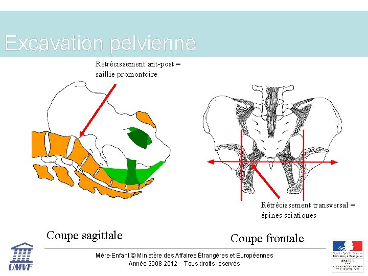 Excavation pelvienne Rétrécissement ant-post = saillie promontoire Rétrécissement transversal = épines sciatiques Coupe sagittale