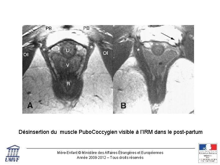 Désinsertion du muscle Pubo. Coccygien visible à l’IRM dans le post-partum Mère-Enfant © Ministère