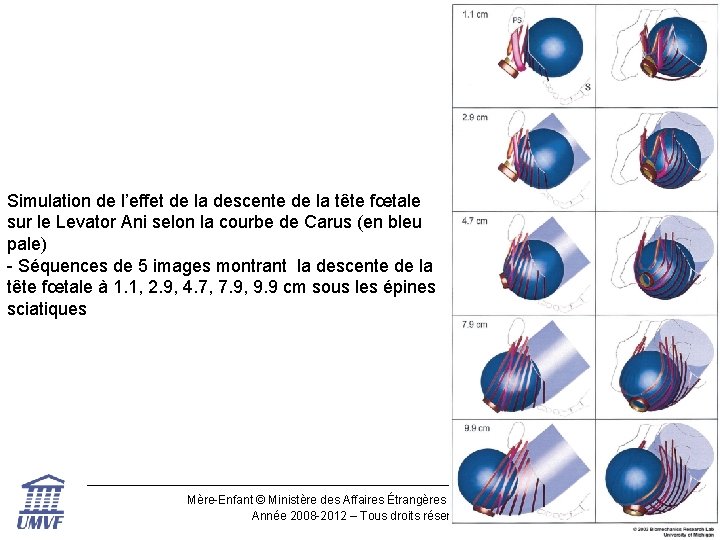 Simulation de l’effet de la descente de la tête fœtale sur le Levator Ani