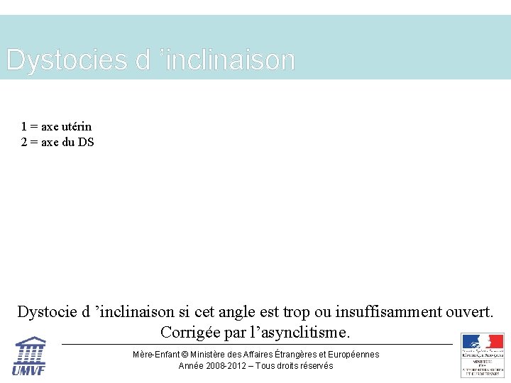 Dystocies d ’inclinaison 1 = axe utérin 2 = axe du DS Dystocie d