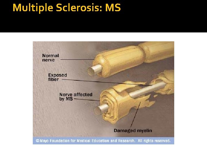Multiple Sclerosis: MS 