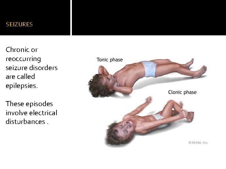 SEIZURES Chronic or reoccurring seizure disorders are called epilepsies. These episodes involve electrical disturbances.
