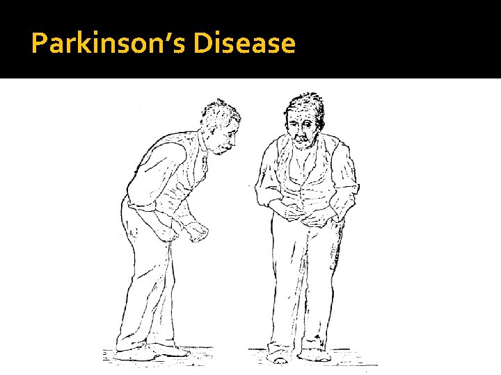 Parkinson’s Disease 