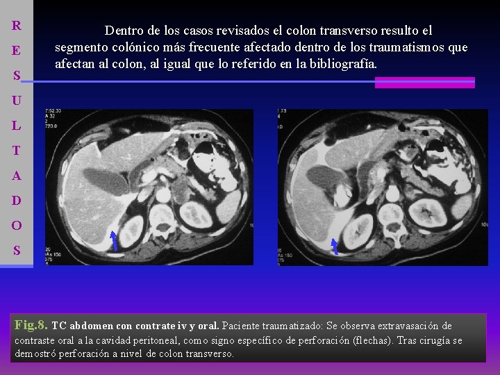 R E S Dentro de los casos revisados el colon transverso resulto el segmento