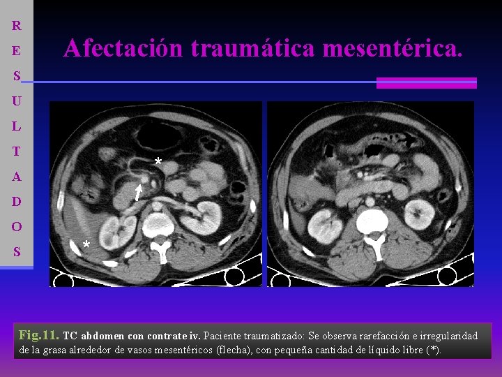 R E Afectación traumática mesentérica. S U L T * A D O S