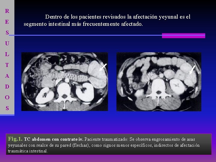 R E Dentro de los pacientes revisados la afectación yeyunal es el segmento intestinal