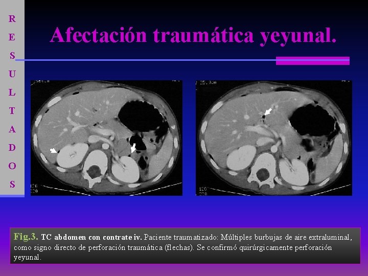 R E Afectación traumática yeyunal. S U L T A D O S Fig.