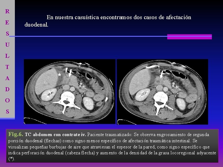 R E En nuestra casuística encontramos dos casos de afectación duodenal. S U L