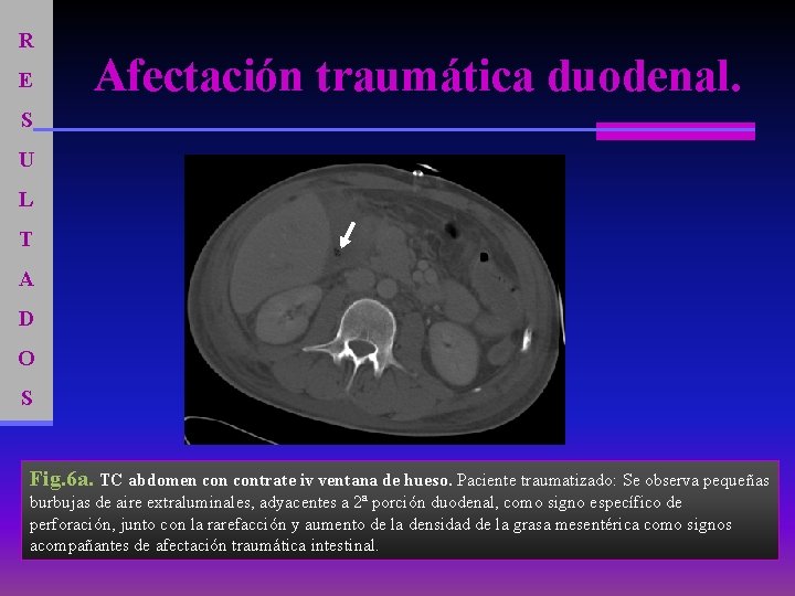 R E Afectación traumática duodenal. S U L T A D O S Fig.