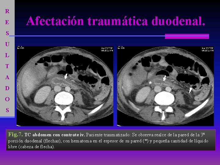 R E Afectación traumática duodenal. S U L T A D * O S