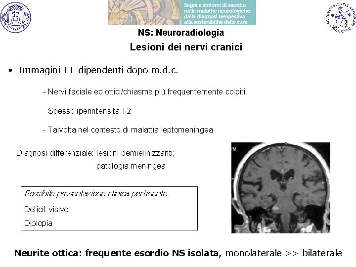 NS: Neuroradiologia Lesioni dei nervi cranici • Immagini T 1 -dipendenti dopo m. d.