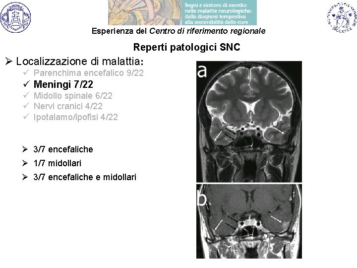 Esperienza del Centro di riferimento regionale Reperti patologici SNC Ø Localizzazione di malattia: ü