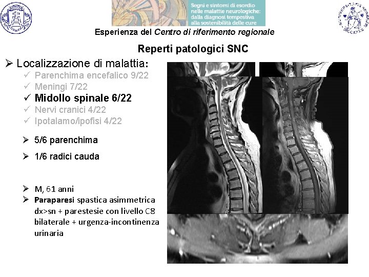 Esperienza del Centro di riferimento regionale Reperti patologici SNC Ø Localizzazione di malattia: ü