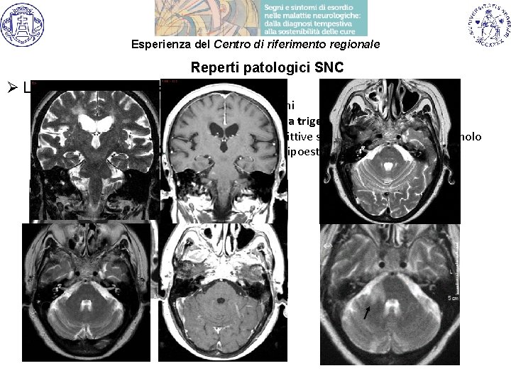 Esperienza del Centro di riferimento regionale Reperti patologici SNC Ø Localizzazione di malattia: ü