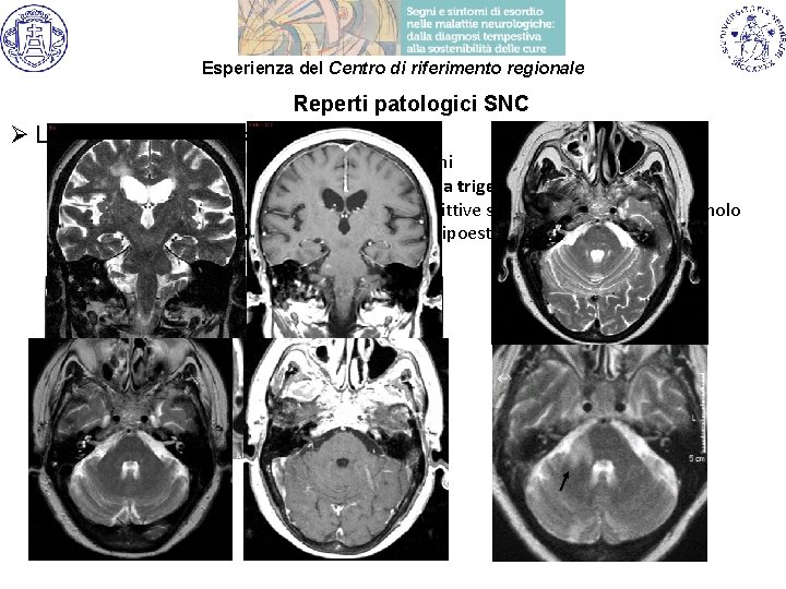 Esperienza del Centro di riferimento regionale Reperti patologici SNC Ø Localizzazione di malattia: ü