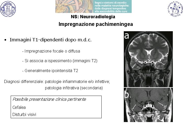 NS: Neuroradiologia Impregnazione pachimeningea • Immagini T 1 -dipendenti dopo m. d. c. -