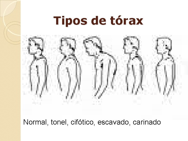 Tipos de tórax Normal, tonel, cifótico, escavado, carinado 