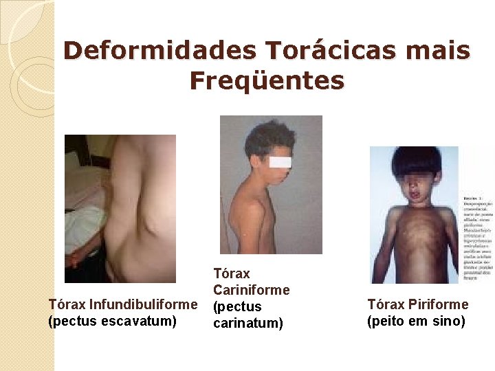 Deformidades Torácicas mais Freqüentes Tórax Infundibuliforme (pectus escavatum) Tórax Cariniforme (pectus carinatum) Tórax Piriforme