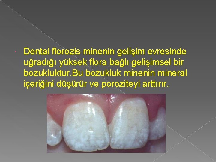  Dental florozis minenin gelişim evresinde uğradığı yüksek flora bağlı gelişimsel bir bozukluktur. Bu