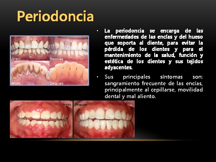 Periodoncia • La periodoncia se encarga de las enfermedades de las encías y del