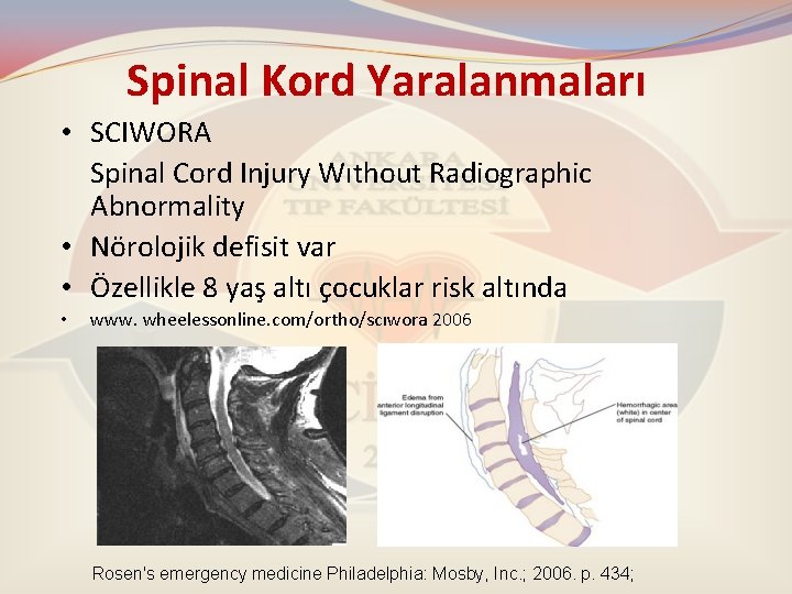 Spinal Kord Yaralanmaları • SCIWORA Spinal Cord Injury Wıthout Radiographic Abnormality • Nörolojik defisit