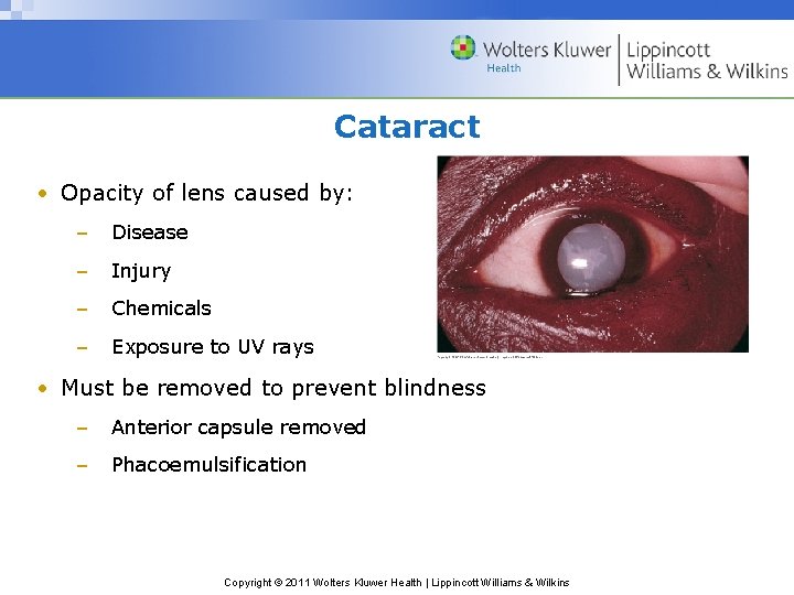 Cataract • Opacity of lens caused by: – Disease – Injury – Chemicals –